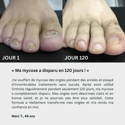 Gel contre les mycoses des ongles GN